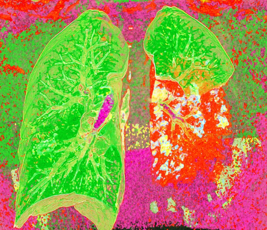 Pneumonia CT scan